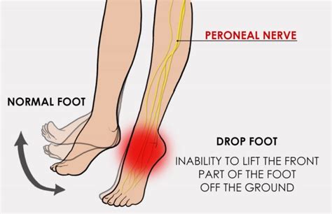 tibial nerve injury physical exam